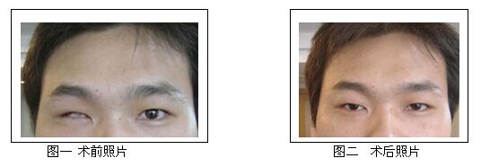 摘除眼球后植入义眼台能恢复到什么程度?