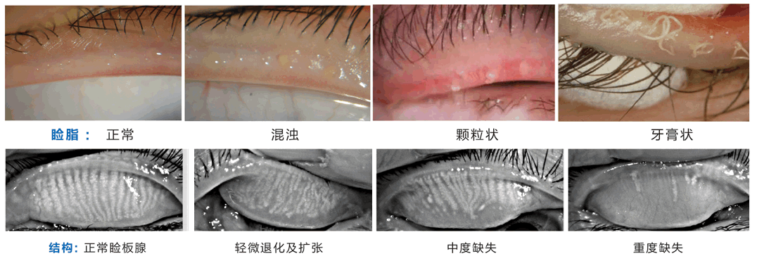 什么是睑板腺功能障碍